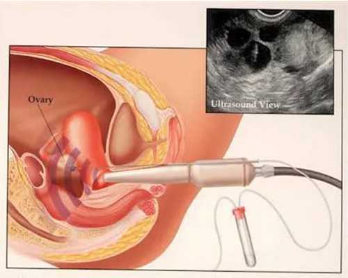 代孕合法的国家及价格&代怀多少钱,提前多久喝碱性水备孕，碱性水备孕的你喝