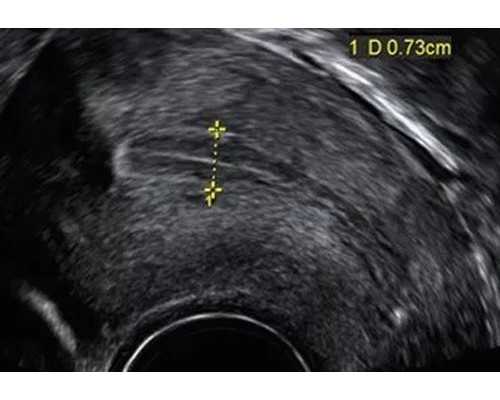 43岁高龄试管成功案例&有供卵的医院吗,备孕二胎 男性应小心4大“拦路虎”